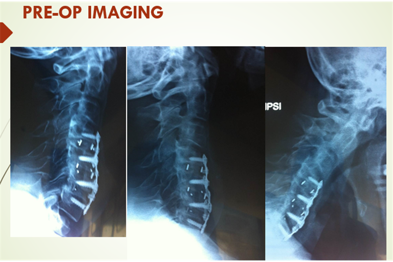 Cervical Myelopathy due to Cervical Kyphotic Deformity in a Patient with Multiple Sclerosis