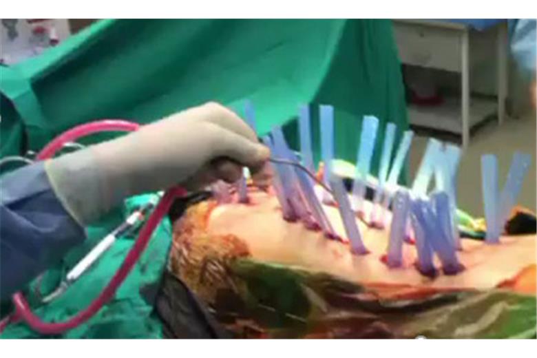 MIS Surgical Treatment for Kyphoscoliosis in a patient with Parkinsons Disease