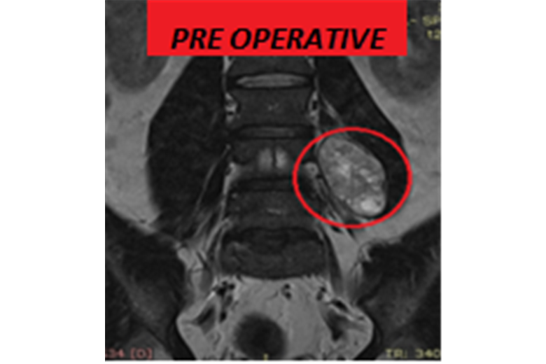 Schwannoma psoas 