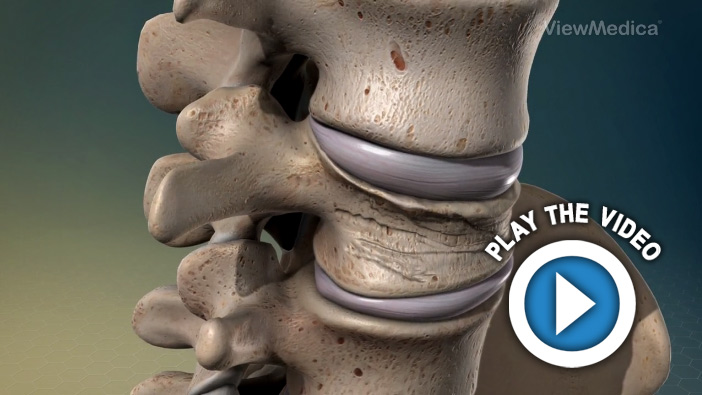 Compression Fractures of the Spine