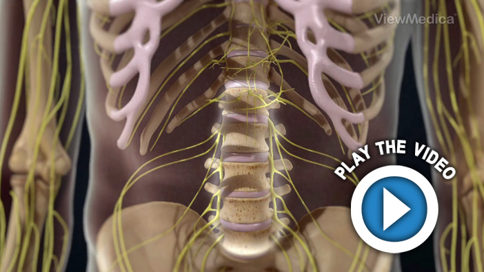 Lumbar Radiculopathy (Sciatica)