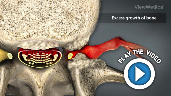 Spinal Stenosis