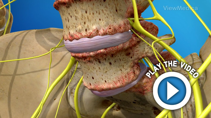 Spondylolisthesis