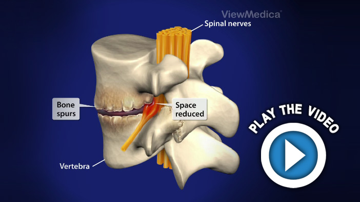 Spondylosis