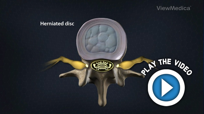  Disc Herniation