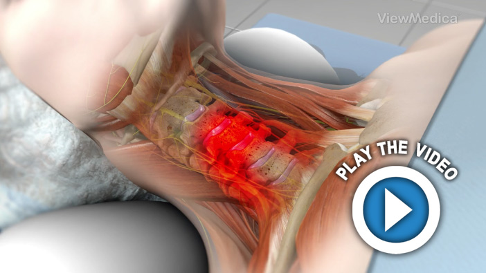 Anterior Cervical Corpectomy