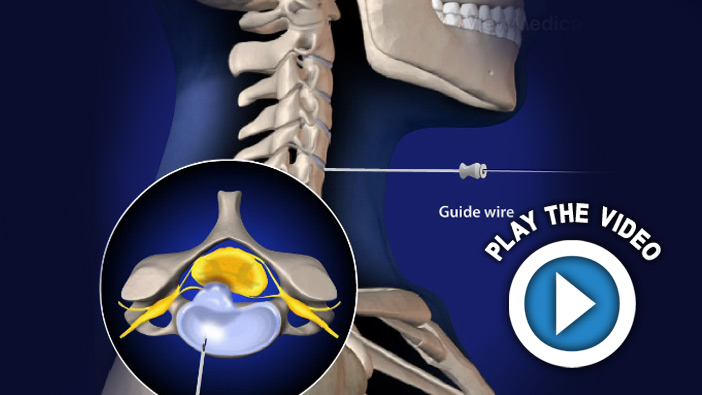 Anterior Endoscopic Cervical Microdiscectomy