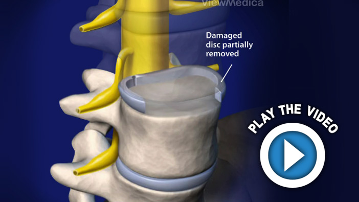 ALIF with bone graft and pedicle screws