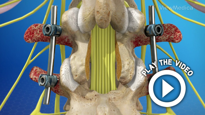 Spinal Fusion (Lumbar)