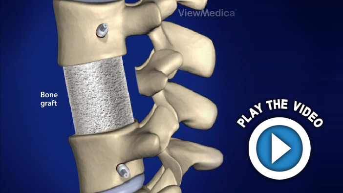 Lumbar Corpectomy