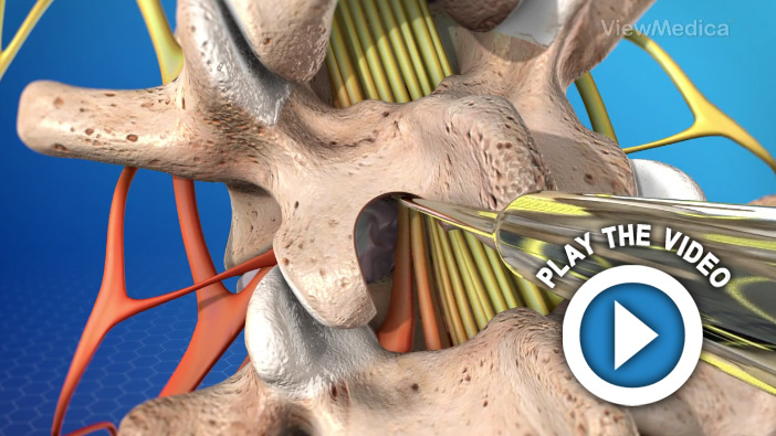 Lumbar Disc Microsurgery