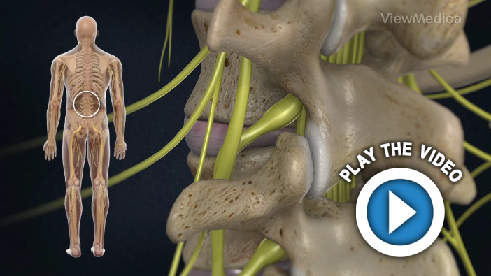 TLIF: Transforaminal Lumbar Interbody Fusion