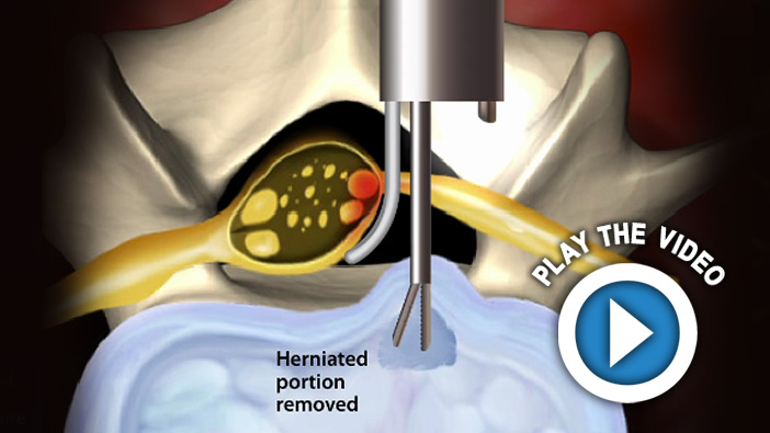 Micro Endoscopic Discectomy