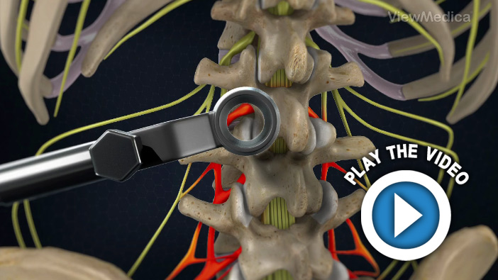 Minimally-Invasive TLIF (Transforaminal Lumbar Interbody Fusion)