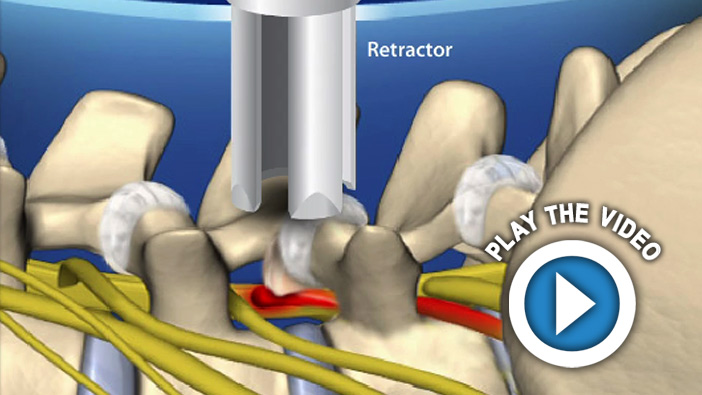 Minimally-Invasive Lumbar Microdecompression