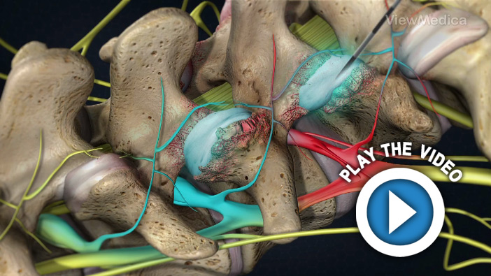 Facet Joint Injections