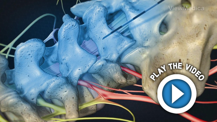 Lumbar Epidural Steroid Injection