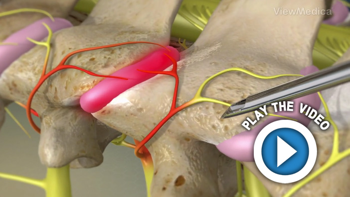 Cervical Facet Radiofrequency Neurotomy