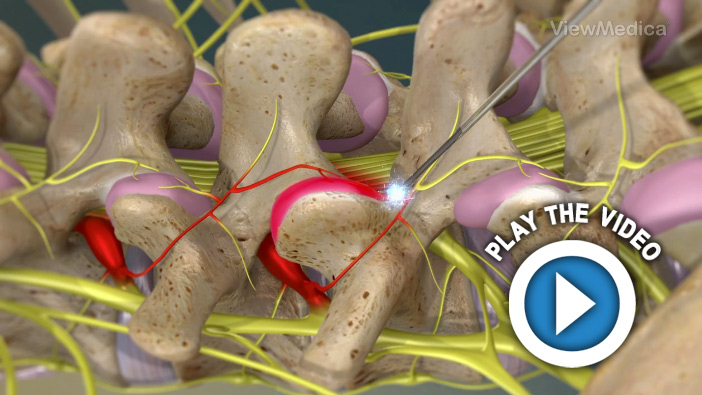 Radiofrequency Neurotomy of the Lumbar Facets