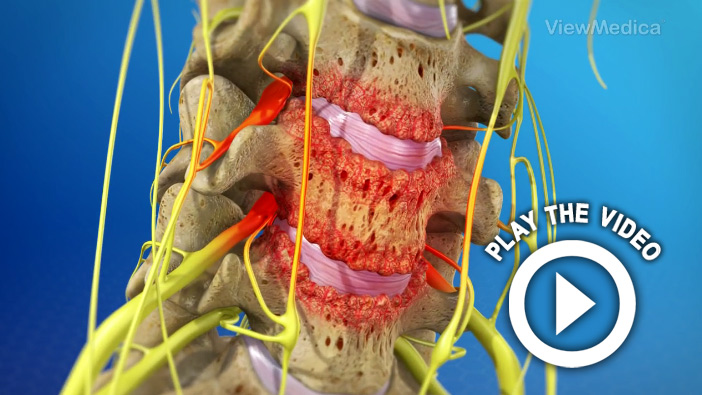 Anterior Cervical Corpectomy (Bone Graft)