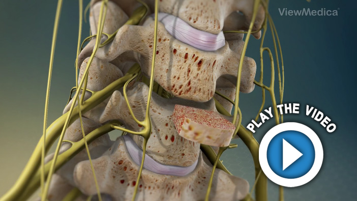 Anterior Cervical Discectomy and Fusion (ACDF)