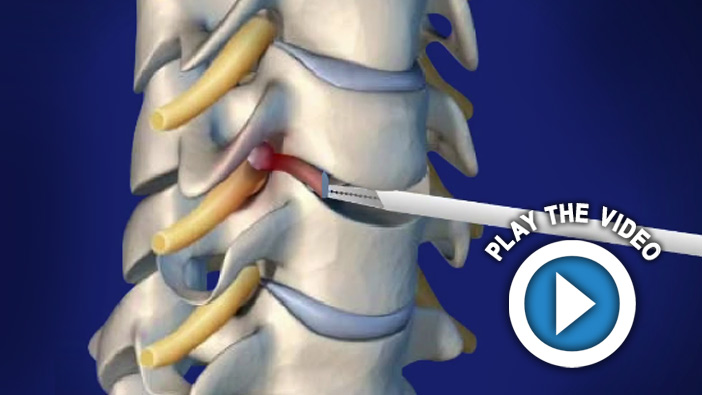 Anterior Cervical Discectomy and Fusion (Intervertebral Spacer)