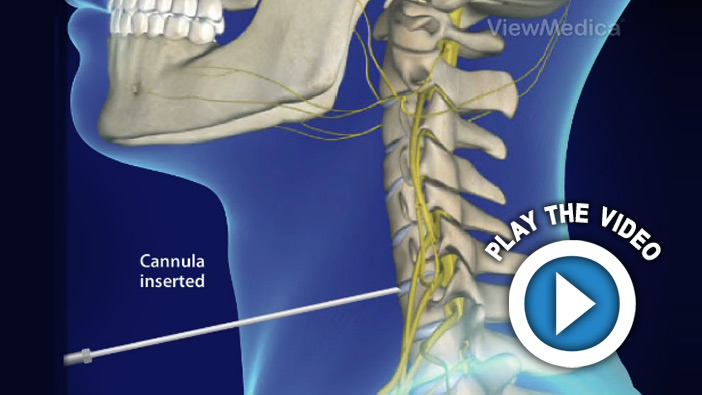 Percutaneous Cervical Disc Nucleoplasty