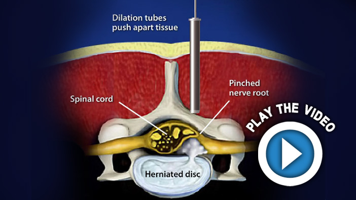 Micro Endoscopic Posterior Cervical Discectomy